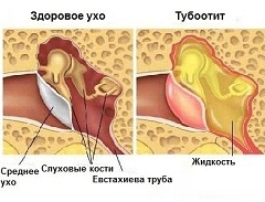 Тубоотит воспаление слизистой оболочки внутреннего уха